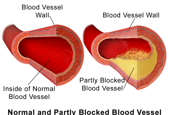 Blausen_0052_Artery_NormalvPartially-BlockedVessel