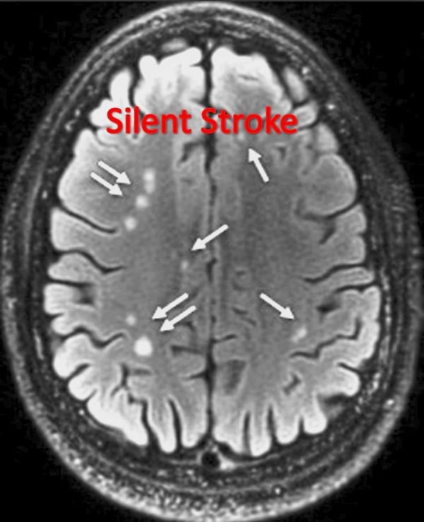 White matter lesion