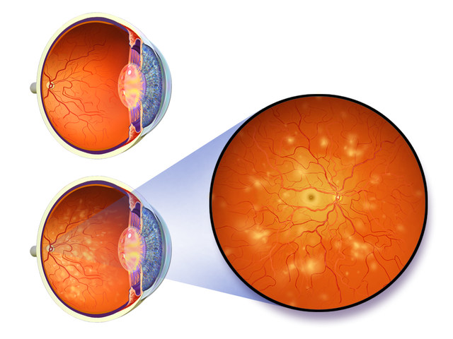 diabetic retinopathy