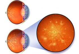 Diabetic Retinopathy